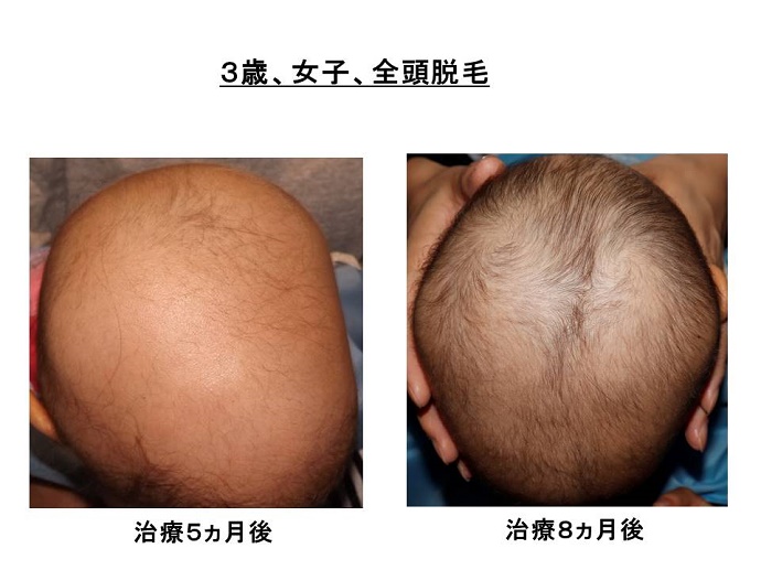円形脱毛症　病院